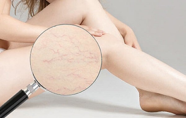 Rạn da tuổi dậy thì: Khắc phục thế nào?