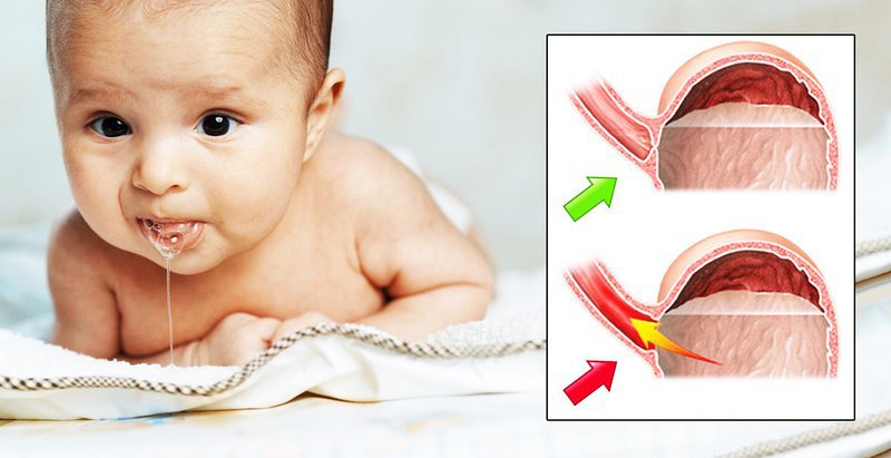 Các triệu chứng trào ngược dạ dày thực quản ở trẻ sơ sinh