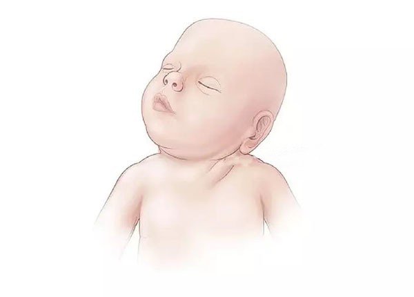 Vẹo cổ ở trẻ nhỏ