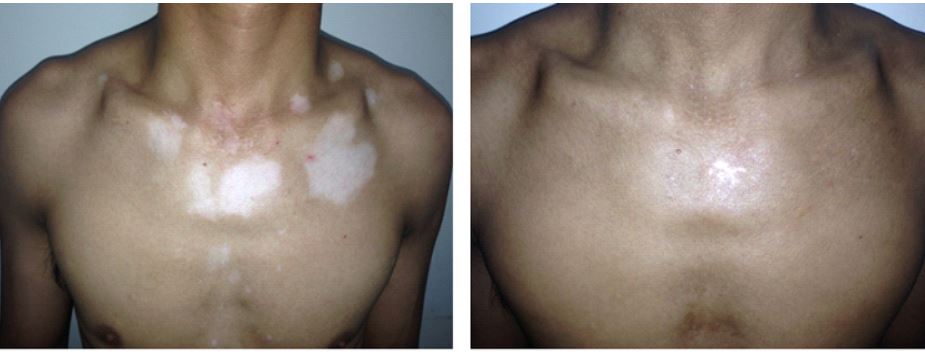 Các phương pháp điều trị bạch biến - bệnh viện da liễu trung ương