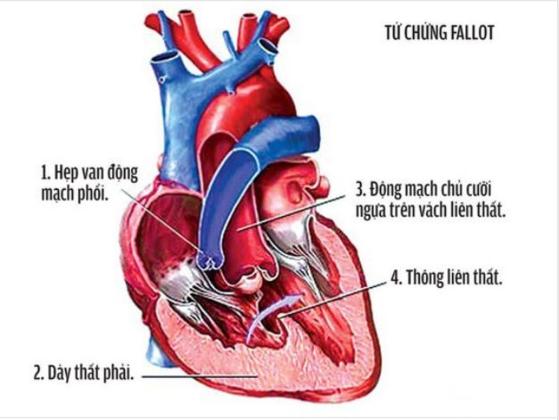DẤU HIỆU NHẬN BIẾT TỨ CHỨNG FALLOT