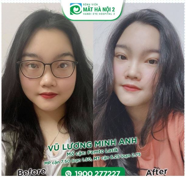 CẬN THỊ KHÔNG TỰ NHIÊN SINH RA, CŨNG KHÔNG TỰ NHIÊN MẤT ĐI NÓ CHỈ NHẢY TỪ ĐỘ CẬN NÀY SANG ĐỘ CẬN KHÁC