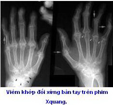 Biểu hiện khớp trong các bệnh tự miễn - Bệnh viện Bạch Mai