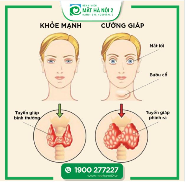 CƯỜNG GIÁP BASEDOW & BIẾN CHỨNG TẠI MẮT