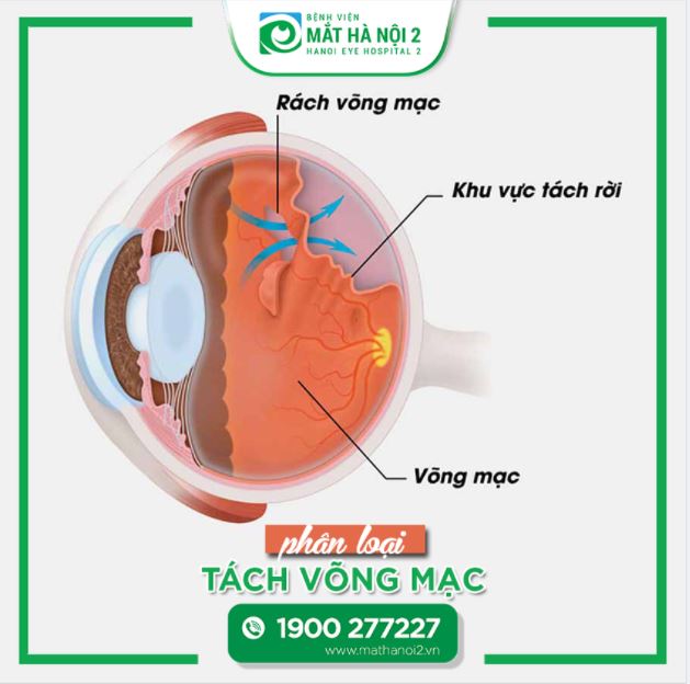 PHÂN LOẠI TÁCH VÕNG MẠC