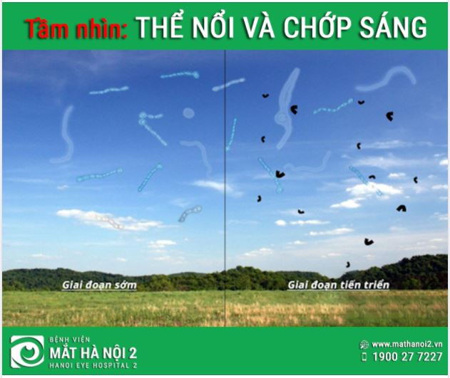 THỂ NỔI VÀ CHỚP SÁNG TRONG TẦM NHÌN
