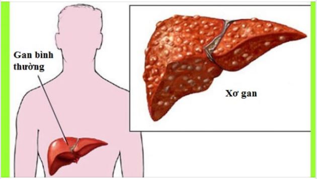 BỆNH XƠ GAN - KHÓ CHỮA NHƯNG DỄ PHÒNG