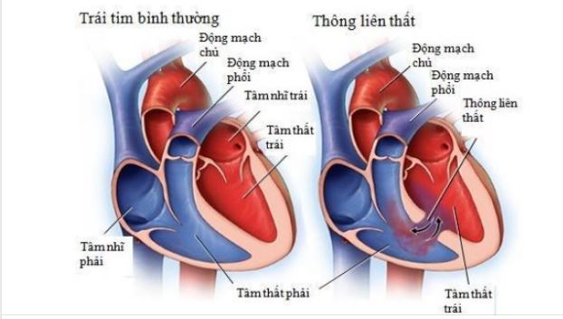 5 LOẠI BỆNH TIM BẨM SINH KHÔNG TÍM THƯỜNG GẶP