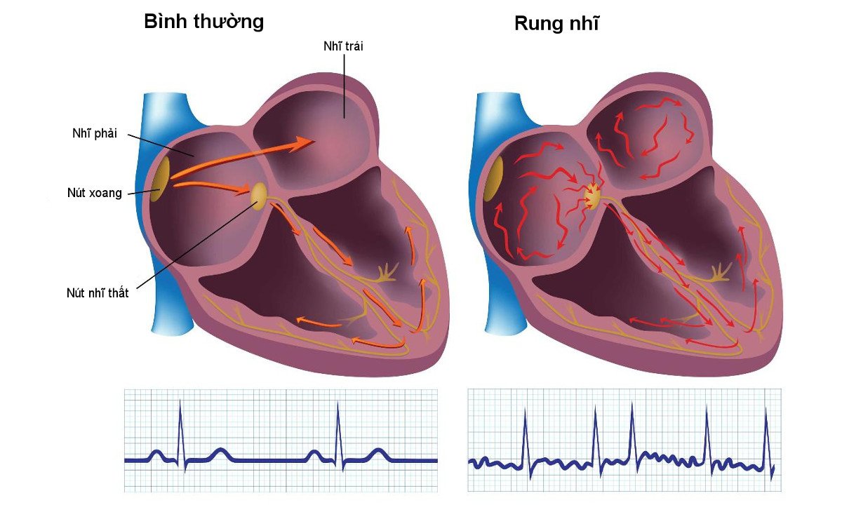 Bít tiểu nhĩ: điều trị dự phòng đột quỵ ở bệnh nhân rung nhĩ