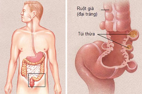 Chẩn đoán viêm túi thừa đại tràng