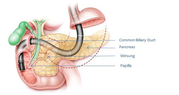 Nội soi mật tụy ngược dòng giúp chẩn đoán bệnh gì?