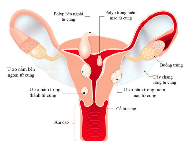Tắc ống dẫn trứng: Nguyên nhân gây vô sinh