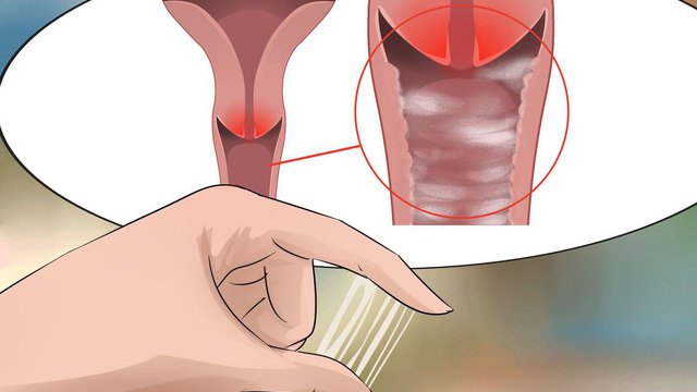 Viêm âm đạo do Trichomoniasis
