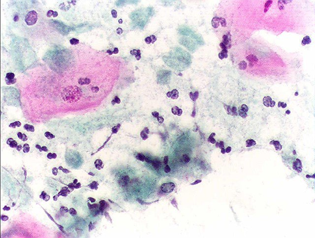 Viêm âm đạo do Trichomoniasis