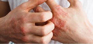 Dầu hạt đen có thể giúp điều trị mụn trứng cá?