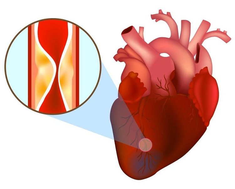 Phân biệt 5 type nhồi máu cơ tim