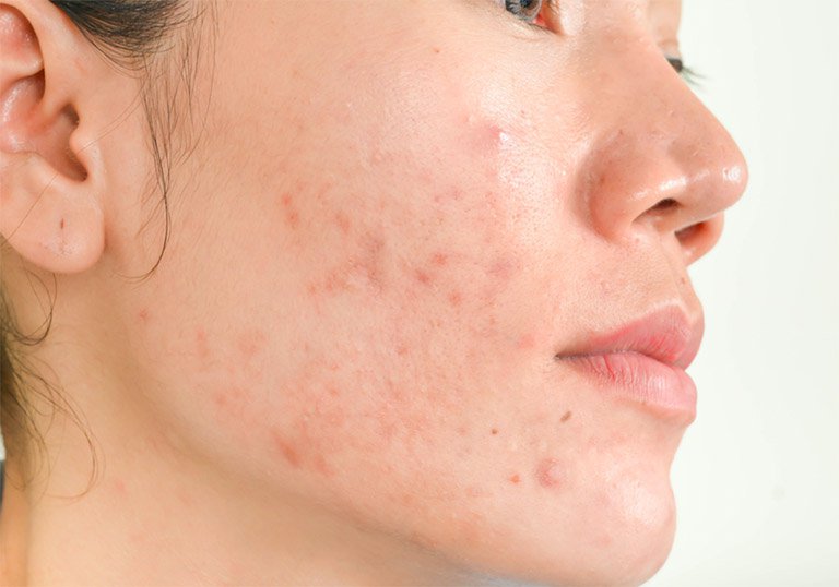 Thay đổi nội tiết tố có thể khiến mụn mọc nhiều hơn