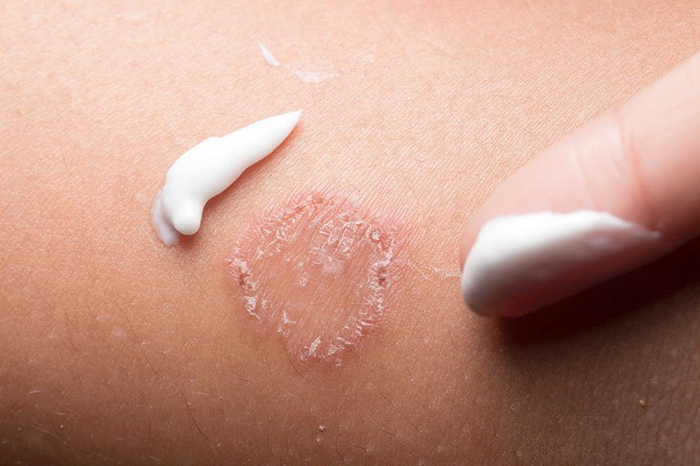 Thuốc chống nấm: Phân loại, cách thức hoạt động