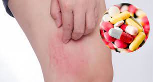 Thuốc Trimethobenzamide HCL: Công dụng, chỉ định và lưu ý khi dùng