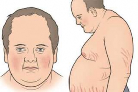 Hội chứng Cushing - Bệnh viện Nội Tiết trung ương