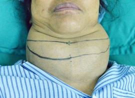 Bướu cổ lành tính khi nào cần mổ? - Bệnh viện Nội Tiết Trung ương