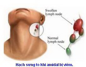 Viêm amidal và cách xử lý - Bệnh viện Bạch Mai