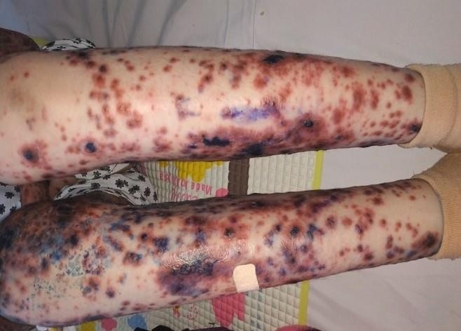 Bé gái Việt mang căn bệnh hiếm, cả thế giới chỉ có 38 trẻ mắc - Bệnh viện Bạch Mai