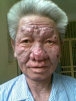 Một ca bệnh da liễu hiếm gặp - Bệnh viện Bạch Mai