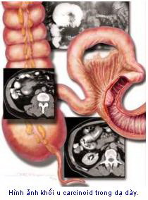 U carcinoid - một dạng ung thư đặc biệt - Bệnh viện Bạch Mai