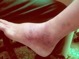 Dấu hiệu cảnh báo sớm trục trặc tim mạch - Bệnh viện Bạch Mai