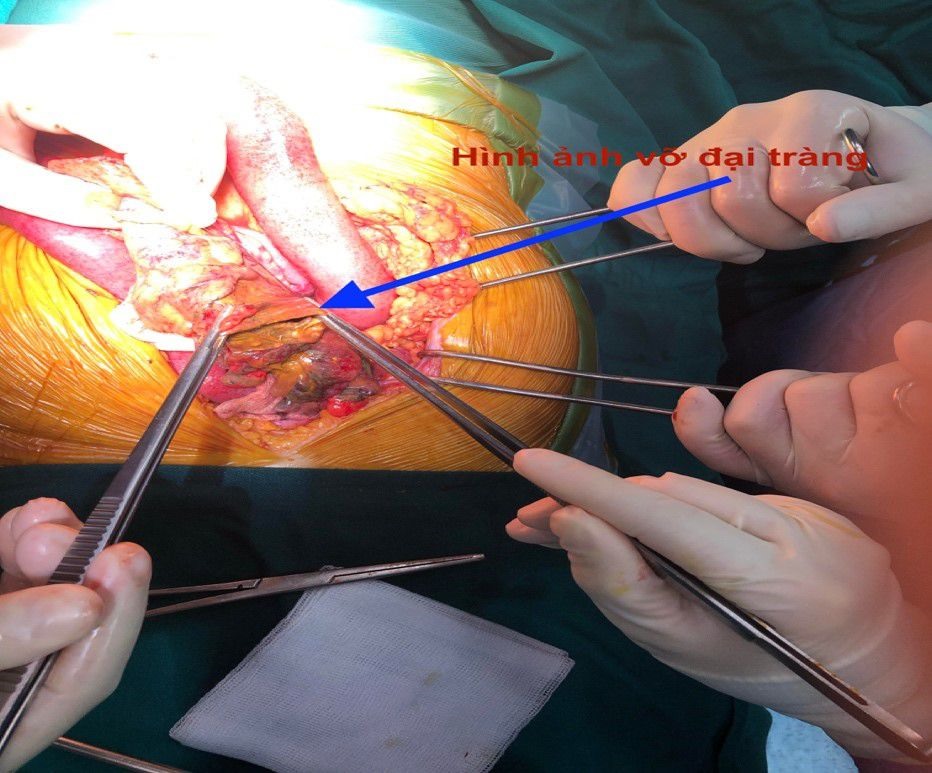 Thủng tạng rỗng nguy hiểm đến tính mạng, nhiều người chủ quan - Bệnh viện Bạch Mai