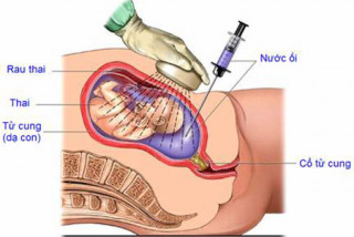 Chọc ối và những điều cần biết - Bệnh viện Hoàn Mỹ Sài Gòn