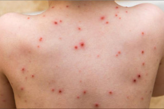 Tìm hiểu về bệnh thủy đậu - Bệnh viện Hoàn Mỹ Sài Gòn