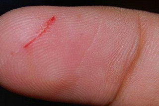 Có thể lây nhiễm vi khuẩn liên cầu qua vết xước trên da - Bệnh viện Hoàn Mỹ Sài Gòn