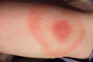 Bệnh Lyme và Xoắn khuẩn Borrelia burgdoferi - Bệnh viện Hoàn Mỹ Sài Gòn