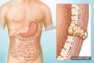 Bệnh lý u mô đệm đường tiêu hóa và cách điều trị - Bệnh viện Hoàn Mỹ Sài Gòn