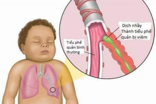 Tại sao bé thường mắc các bệnh nhiễm trùng đường hô hấp - Bệnh viện Hoàn Mỹ Sài Gòn