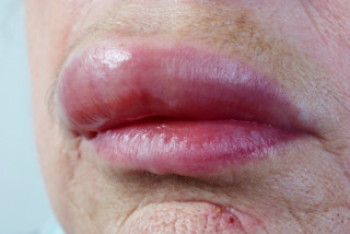 Phù quincke, bệnh thường nhầm với quai bị - Bệnh viện Hoàn Mỹ Sài Gòn