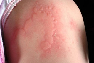 Nguyên nhân gây bệnh mày đay - Bệnh viện Hoàn Mỹ Sài Gòn