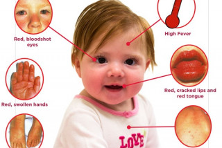 Cảnh báo trẻ mắc căn bệnh nguy hiểm mang tên Kawasaki - Bệnh viện Hoàn Mỹ Sài Gòn