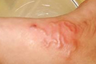 Bệnh giun lươn có thể gây ra nhiều biến chứng nguy hiểm - Bệnh viện Hoàn Mỹ Sài Gòn