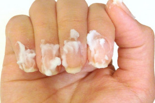 Điều trị bệnh nấm móng như thế nào? - Bệnh viện Hoàn Mỹ Sài Gòn