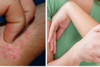 Trời lạnh, bệnh về da tăng - Bệnh viện Hoàn Mỹ Sài Gòn