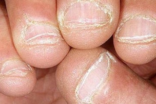 Bệnh nấm móng và những lưu ý - Bệnh viện Hoàn Mỹ Sài Gòn