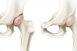 Thay khớp háng nhân tạo điều trị hoại tử chỏm xương đùi - Bệnh viện Hoàn Mỹ Sài Gòn