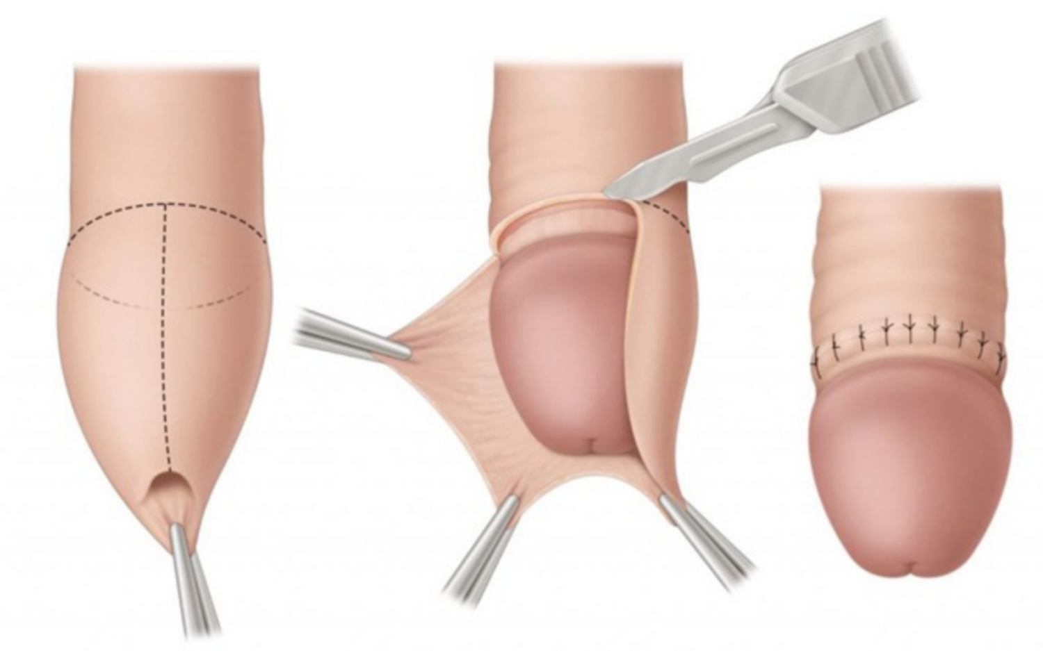 Những điều cần biết về cắt bao quy đầu