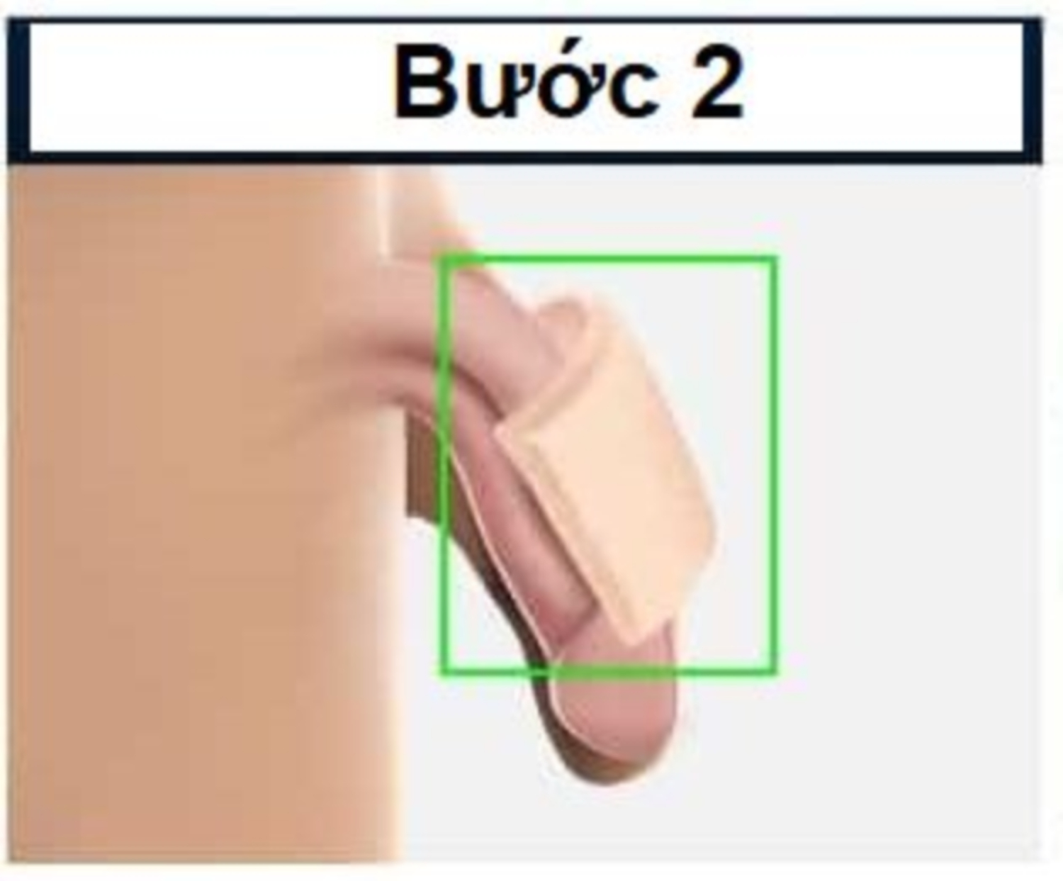Bóc tách tạo khoang dưới da, đặt tấm mô da ôm lấy thân dương vật