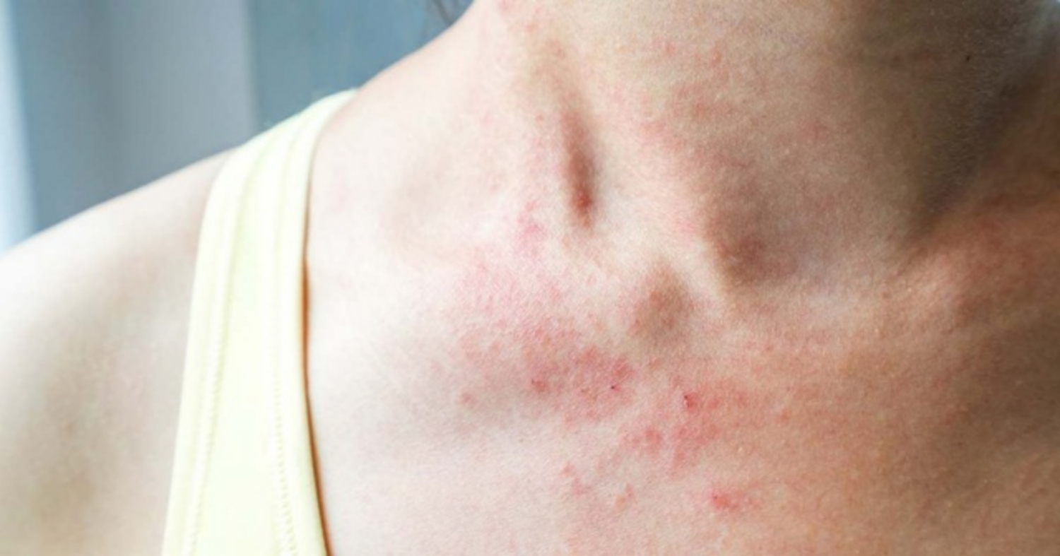 Bệnh viêm da dị ứng: Triệu chứng, nguyên nhân và điều trị