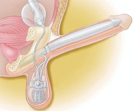 Phục hồi dương vật cho bệnh nhân bị bỏng điện cao thế - Nam khoa Penuma