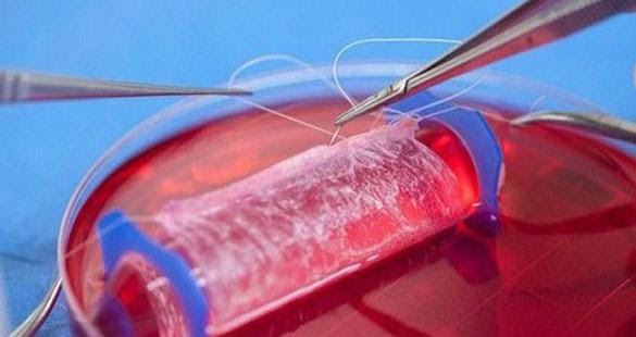Tạo dương vật mới cho bệnh nhân nam phải ngồi tiểu suốt 10 năm - Nam khoa Penuma